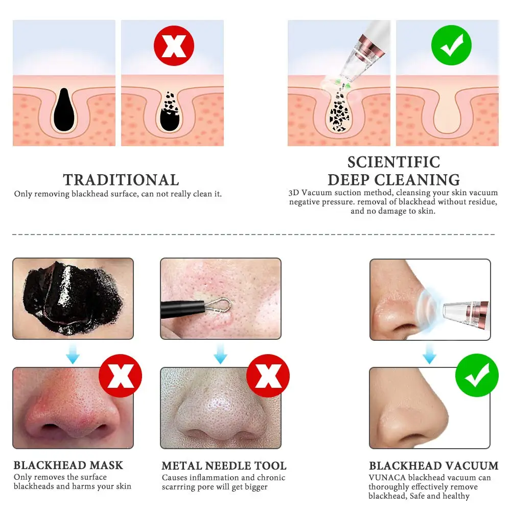 
Wholesale Home Use Beauty Personal Care Pimple Extractor Comedo Suction Blackhead Extractor Tool Set 