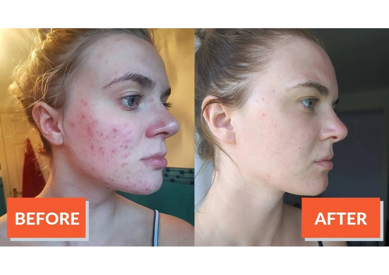 scar free face cream