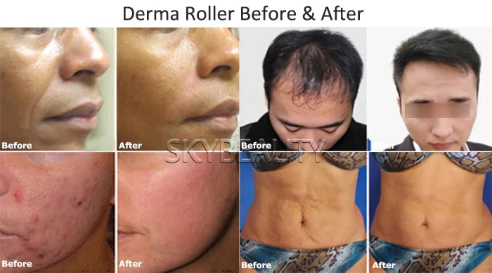 Derma Roller Before After.jpg