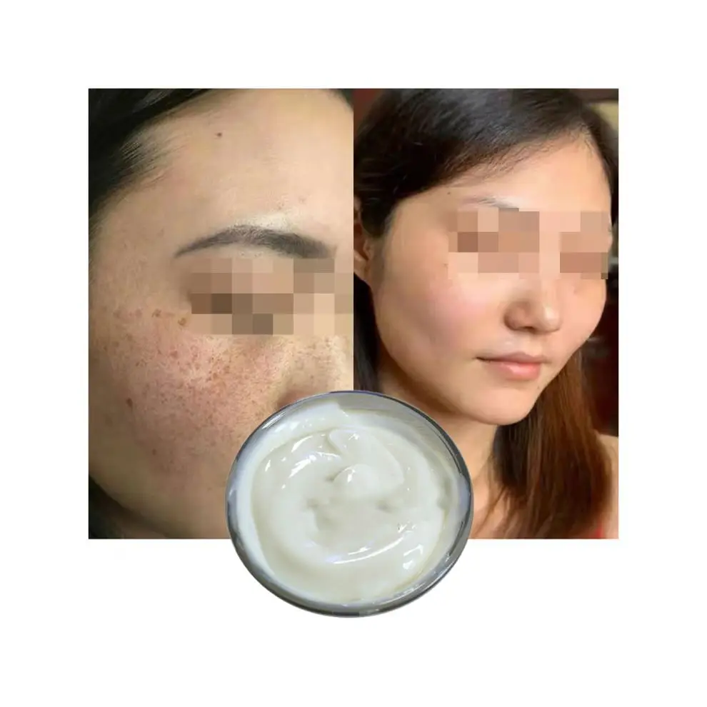 

Pimples Face Cream Semi-finished Base Advanced Pro mixing Promixing Pimples Eradicator Soap Sold by Weight