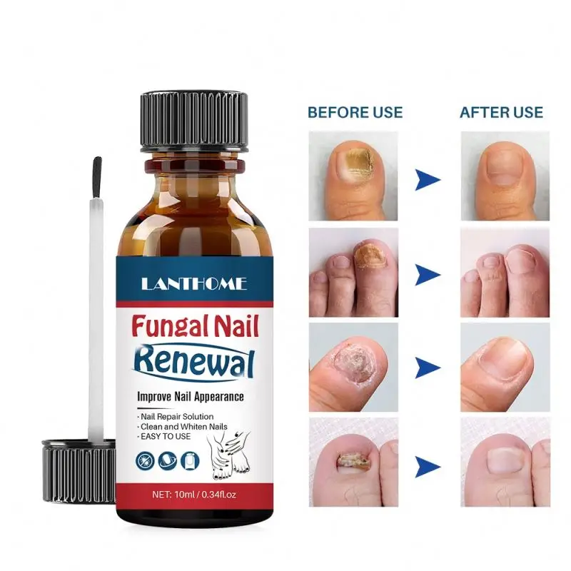 

Easy To Use Improve Nail Appearance Finger Repair Solution Foot Fungus Infection Treatment for Ingrown Toe Nail