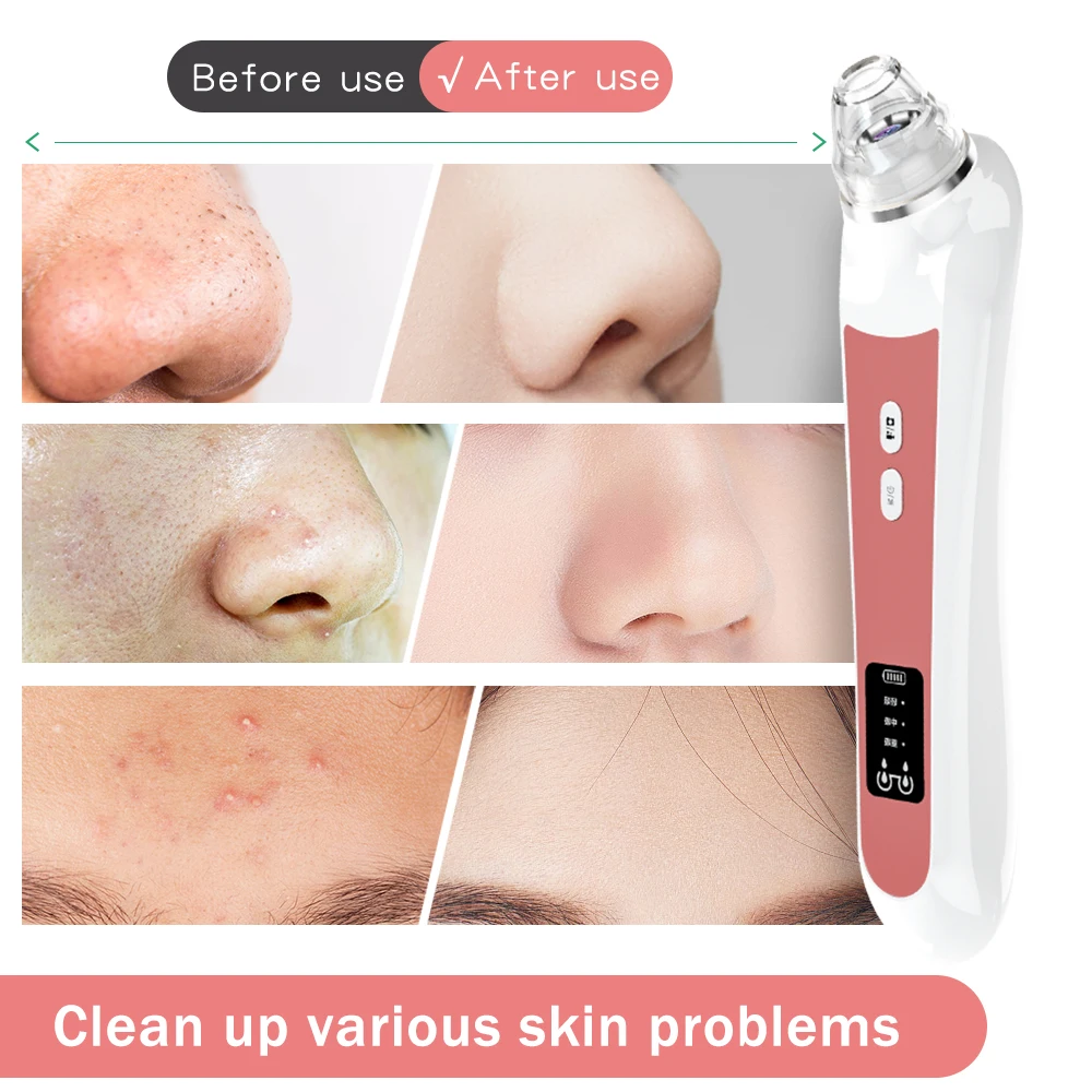 vacuum blackhead remover