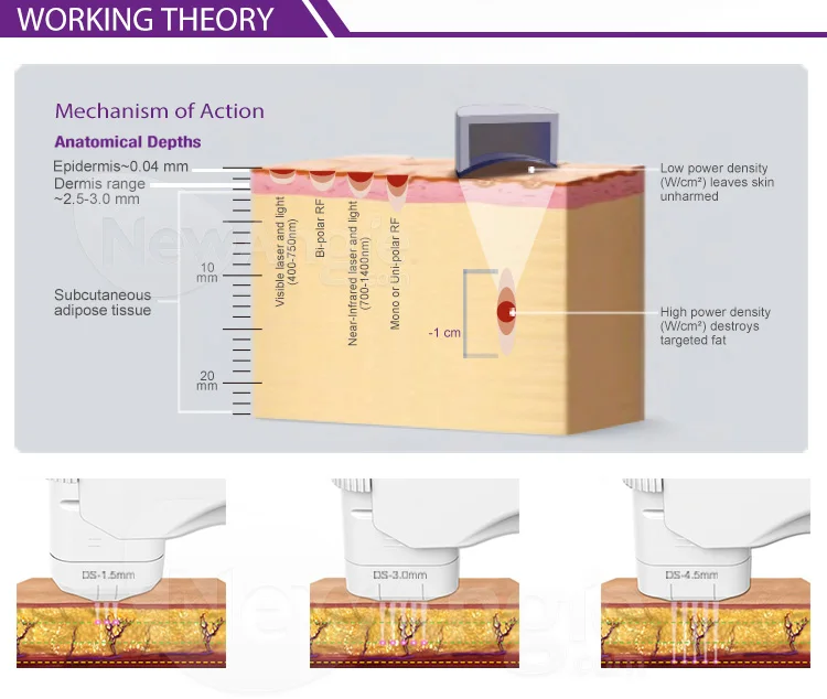 hifu machine  (3).jpg