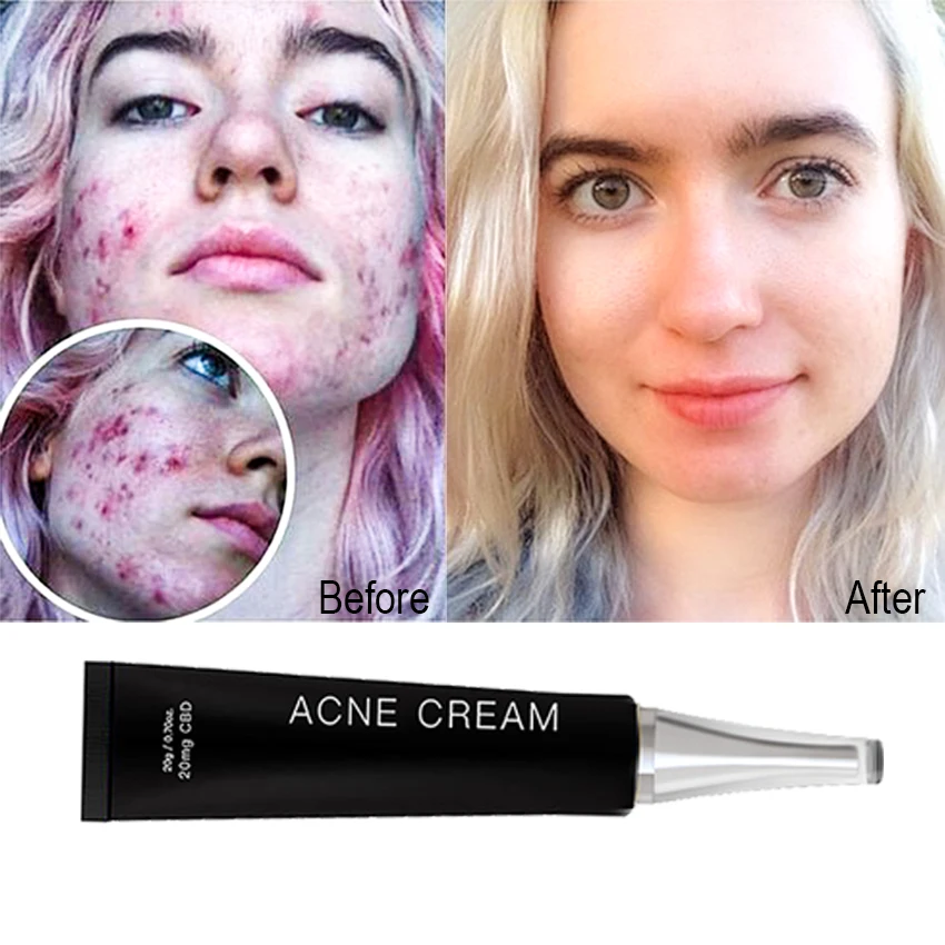 

High Quality Factory Supply Anti Acne Cream Best Skin Scar Remove Cream For Face