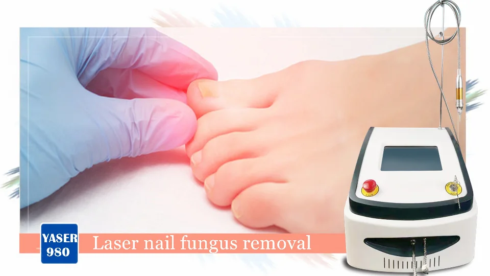 980 нм. Diode Laser 980 NM. Аппарат для удаления грибковых ногтей. Лечение грибка ногтей лазером диодным. , Лазерное устройство для лечения грибка на ногтях.