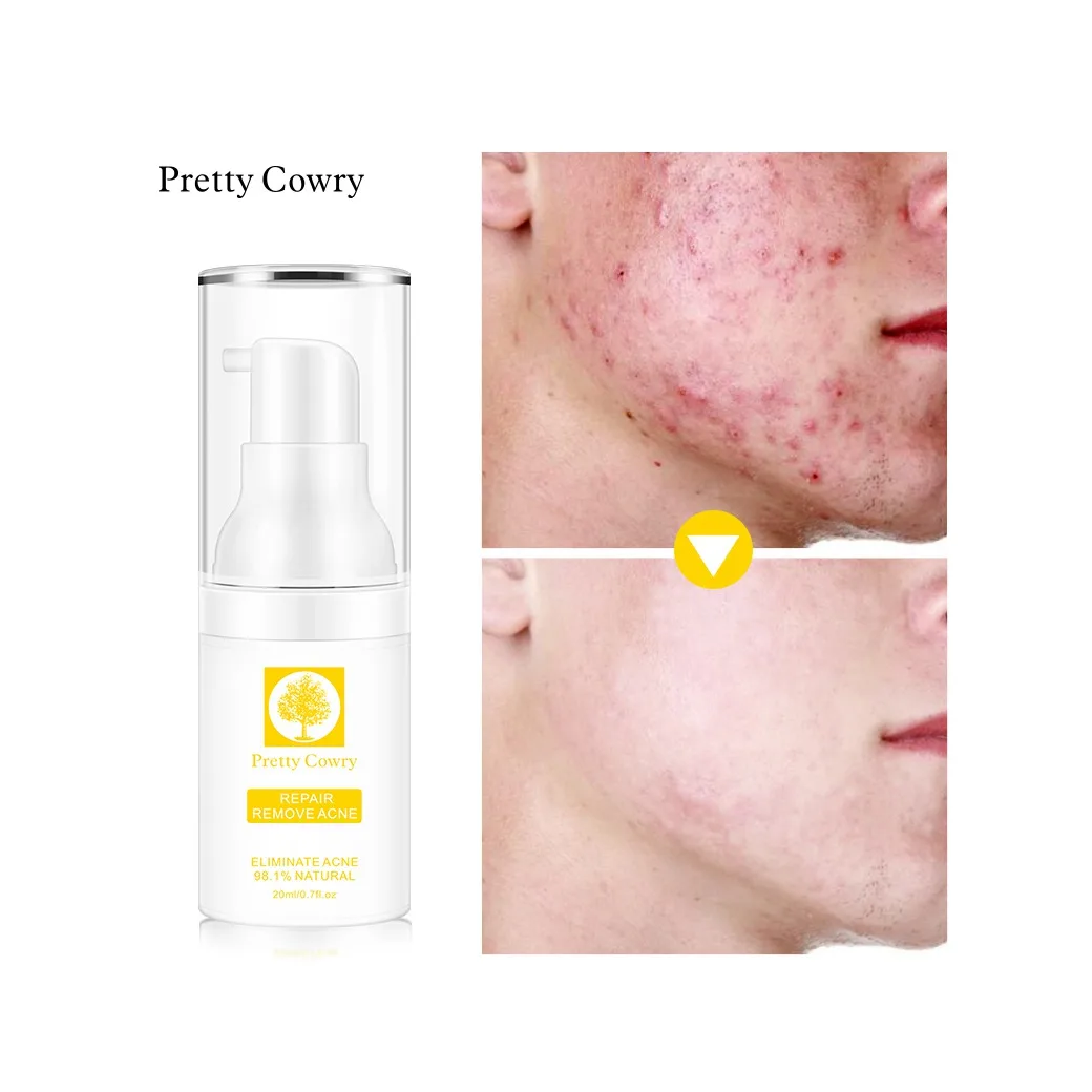 

professional Natural Herbal Extract Hydrating 7 days effective Repair Acne Pimple Remove Treatment Cream