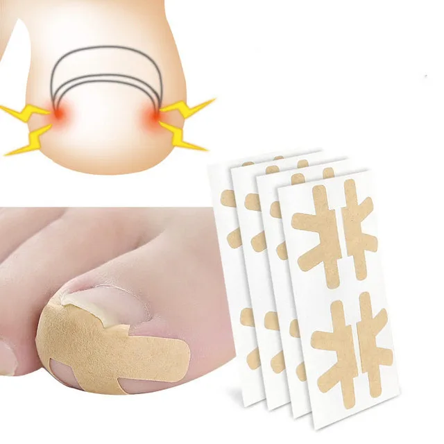 

4 pcs Glue Free Ingrown Toenail Correction Tool Pedicure Sticker Inflammatory Toenail Orthotic Patch Toe Nail Correct Sticker, Skin