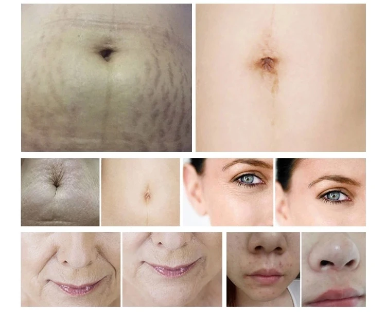 New Edition Microneedle Rf Machine Facial Lifting Beauty Instrument Skin Rejuvenation Machine for Spa and Clinic Use