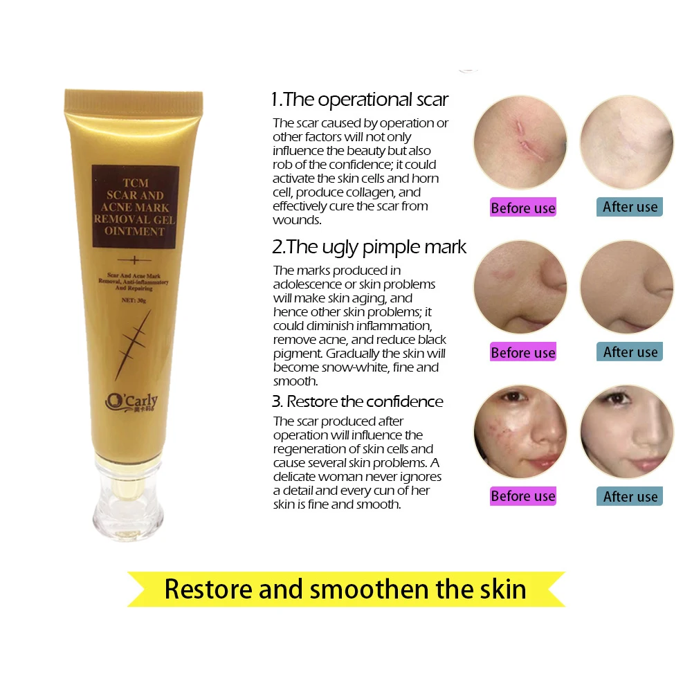 Tcm Scar And Acne Mark Removal Gel Ointment Anti-inflammatory And ...