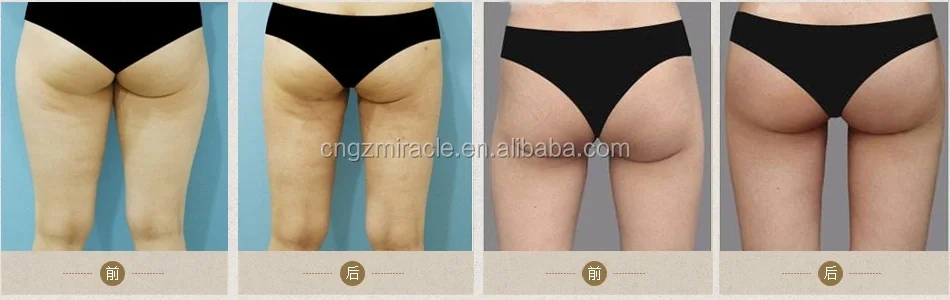 Breast-Enlargement-17