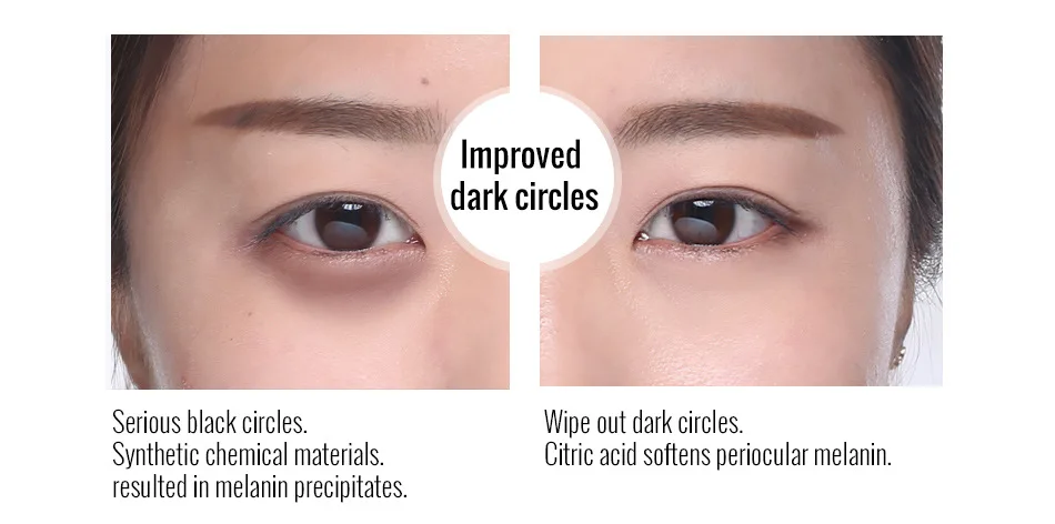 best instant eye bag removal