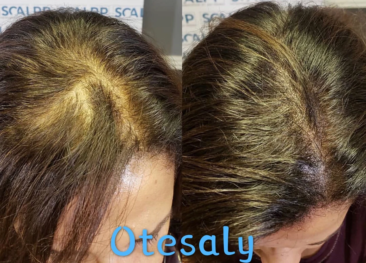 Best Results Hair Growth Mesotherapy Solution For Antihair Loss 10