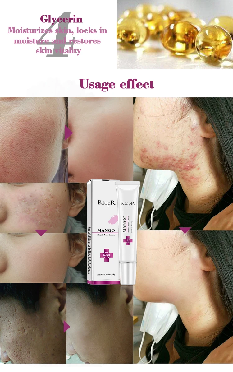 Private Label Herbal Korea Best Anti Pimple Removing Fade Face Treatment Acne Scar Removal Cream