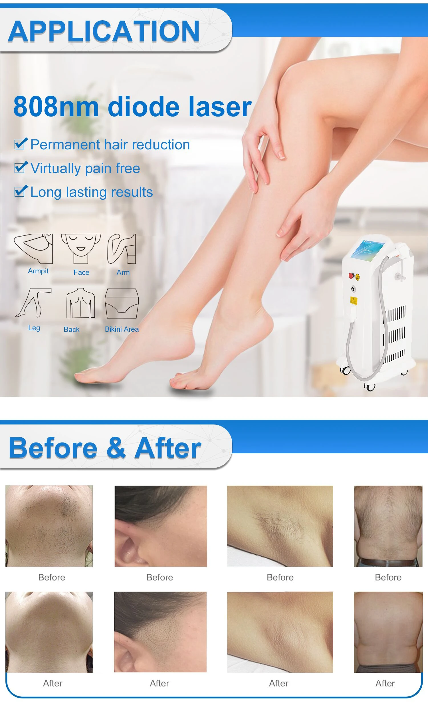 Maquinas De Depilacion Permanente Laser Hair Removal Deka Motus Ax Moveo Laser  Hair Removal For White Hair Laser - Buy Tuv Tga Approved Laser Hair Removal  Machine,Laser Diodo Hair Removal 2000w,All Skin