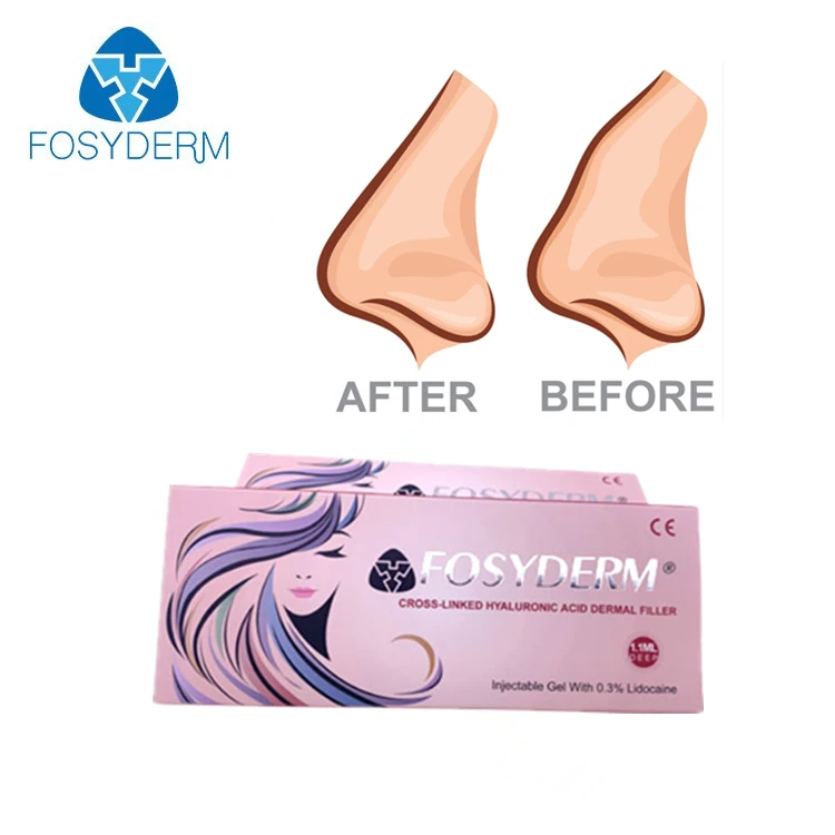 

Fosyderm Nose Filler Injection Hyaluronic Acid Deep 1ml Dermal Filler