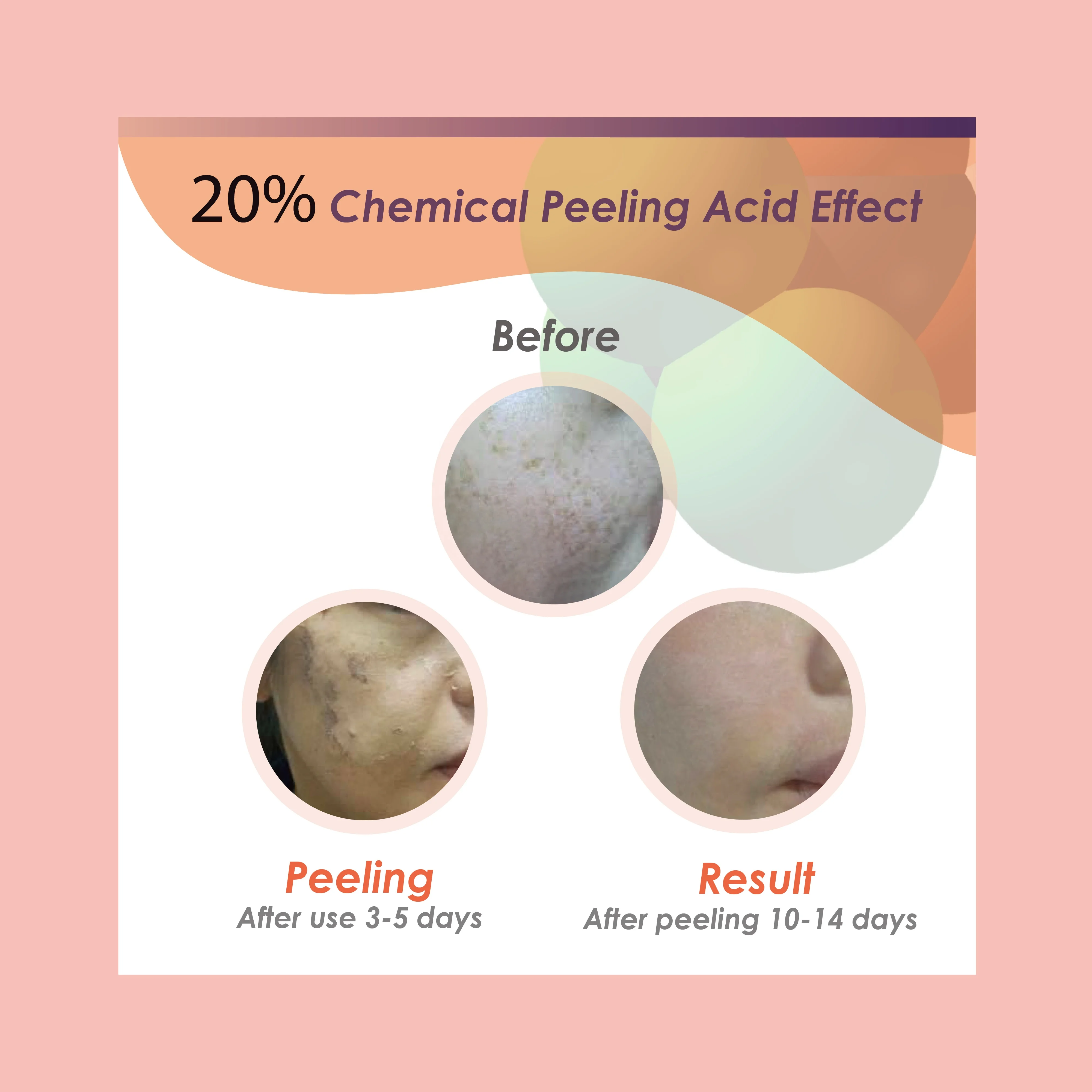 Private Label Acne Scar Serum 20% Peel Remove Blemish Chemical Skin Peeling - Buy Prime 20% Tca ...
