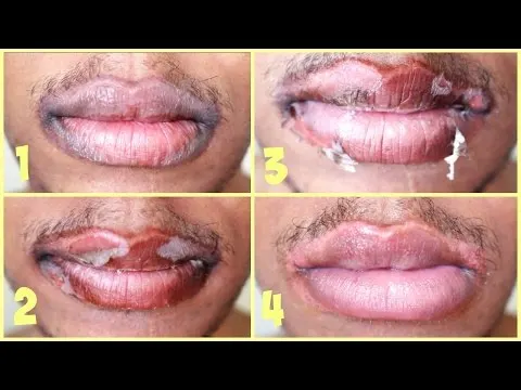 20 tca home chemical peel instructions with pictures. 20 tca home chemical peel instructions with pictures.