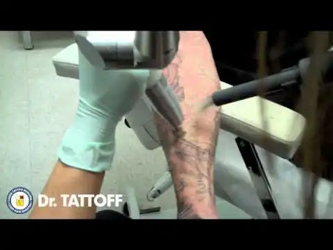 cheap laser tattoo removal surgery find laser tattoo removal cheap laser tattoo removal surgery find laser tattoo removal