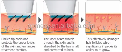 2017 CE approved Big sale Vertical 10 BARS shr didoe laser for beauty salon 