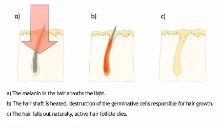 セリウムの証明書のダイオード レーザー装置の痛みのない毛の取り外しの顔の毛の除去剤IPLレーザーの携帯用版アルマplatinum.jpgを使って