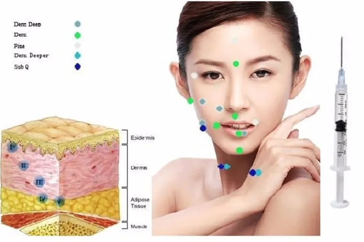 10ml Cosmetics filler injection hyaluronic acid products for buttock enhancement