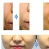 Bloomfill Meso Solution : PLLA Meso Solution with Growth Factor