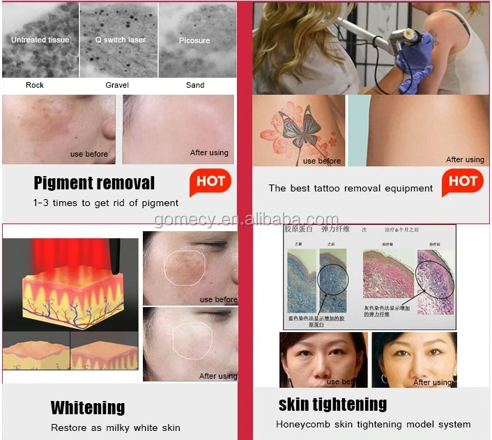 Picosure acne scars fast tattoo removal salon beauty machine.jpg