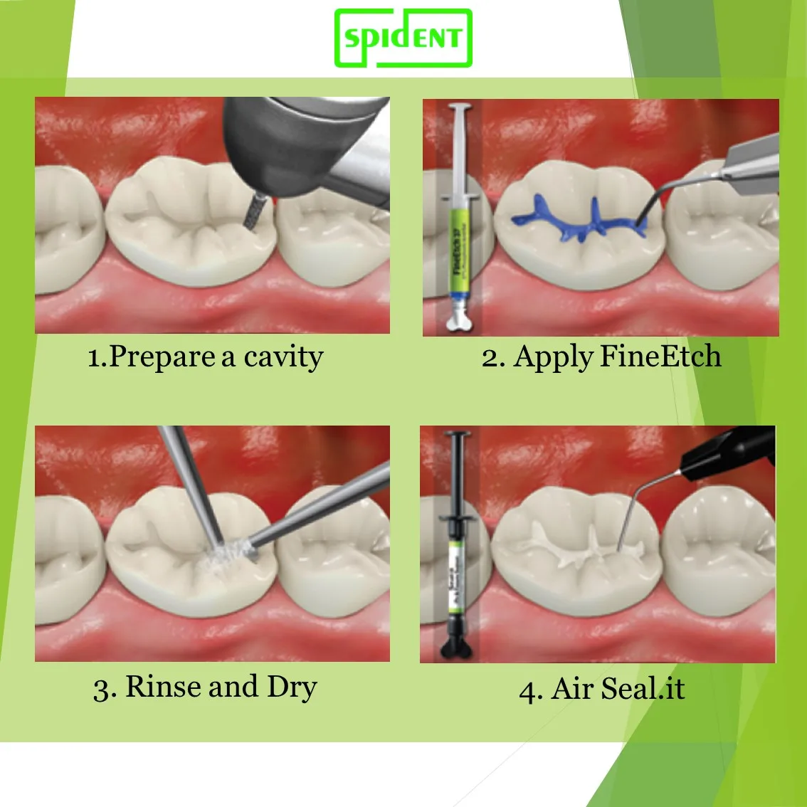 Dental Light Cured Sealants For Enamel Pit And Fissure Buy Pit And