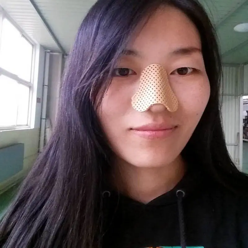 Fracture Nose Splint Medical Nose Guard Thermoplastic Nasal Splint ...