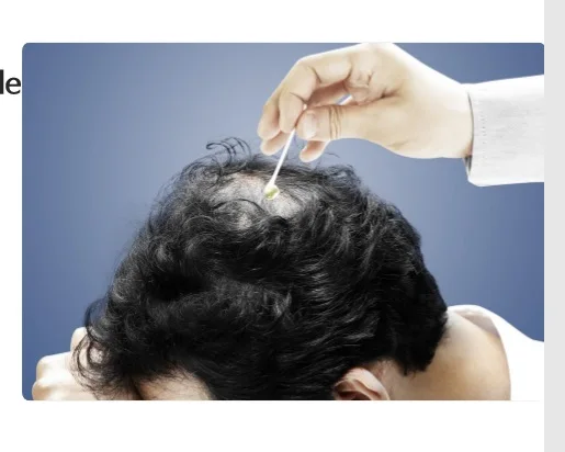 
MOMOCOME DERMA PEPARING SCALP AMPULE - ANTI HAIR LOSS PRODUCT 