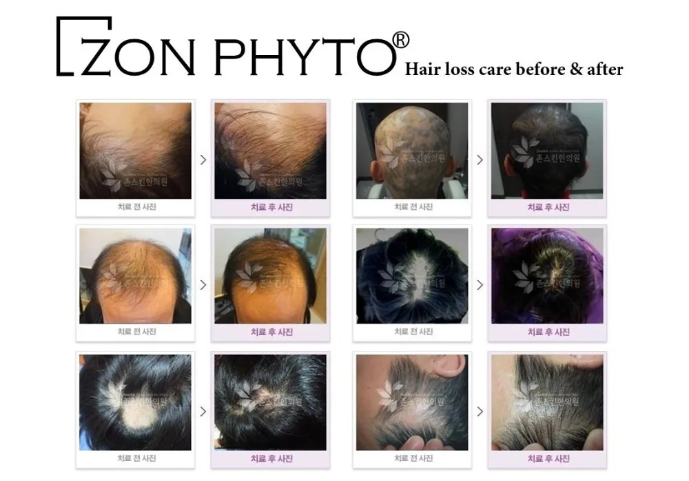 Scalp Ph Balancing Hair Loss Ampoule With Enhancing Scalp And Blood