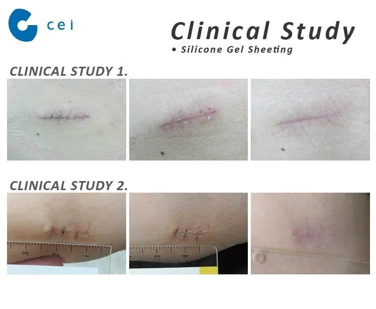 silicone scar treatment sheets