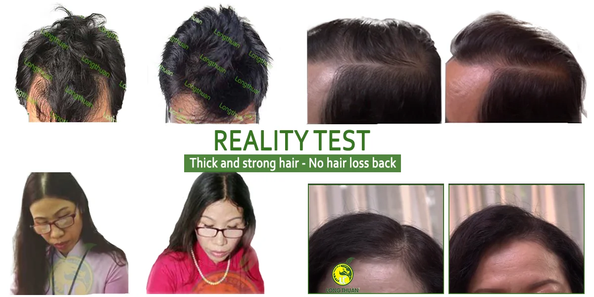 Vitamins Thick Hair Growth Spray For Hair Loss Buy Hair