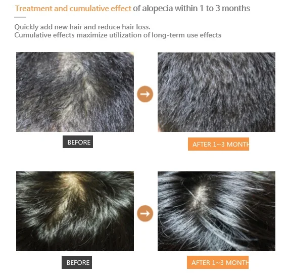 
MOMOCOME DERMA PEPARING SCALP AMPULE - ANTI HAIR LOSS PRODUCT 