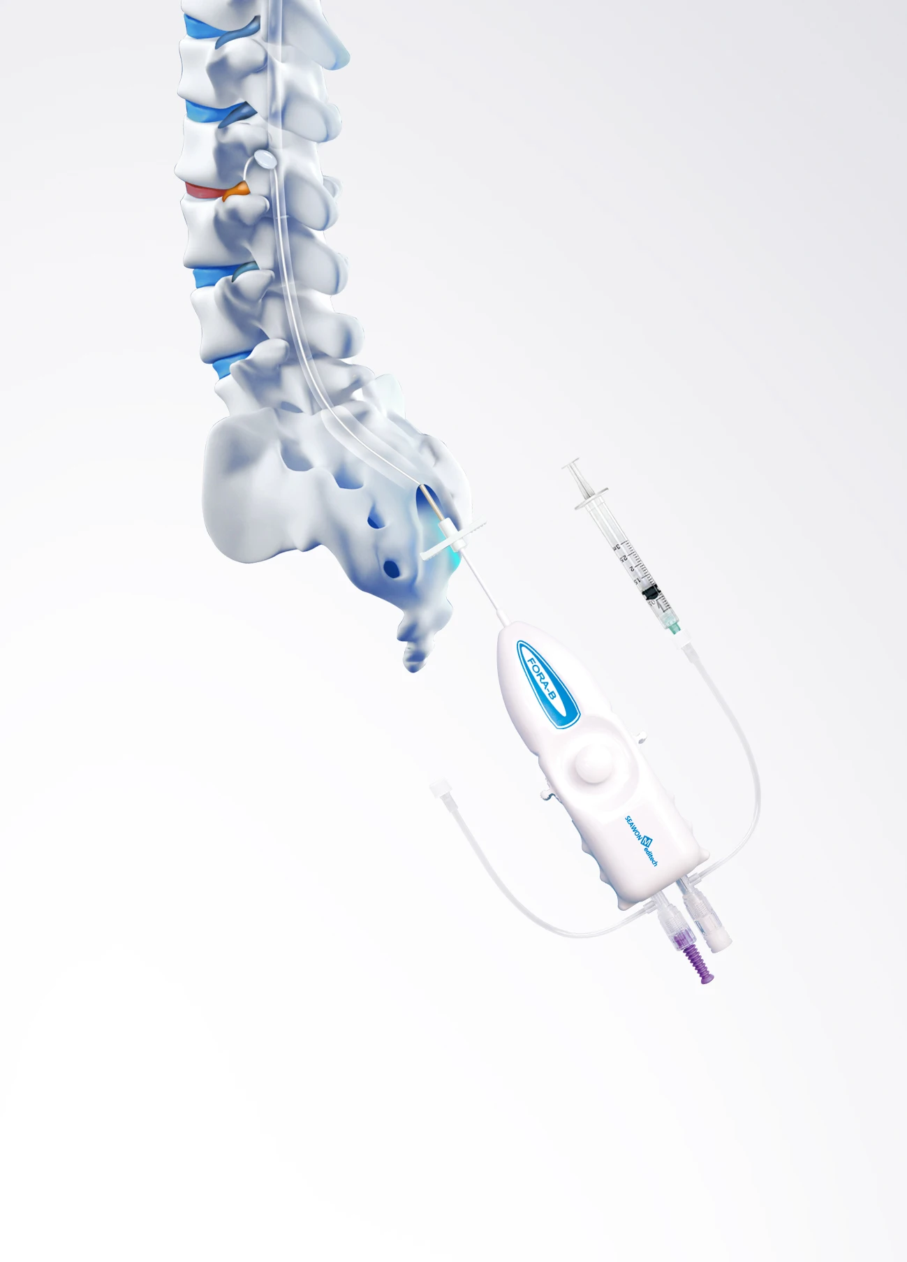 Steerable Epidural Ballooncatheter Forab Lumbar Buy Balloon Catheter