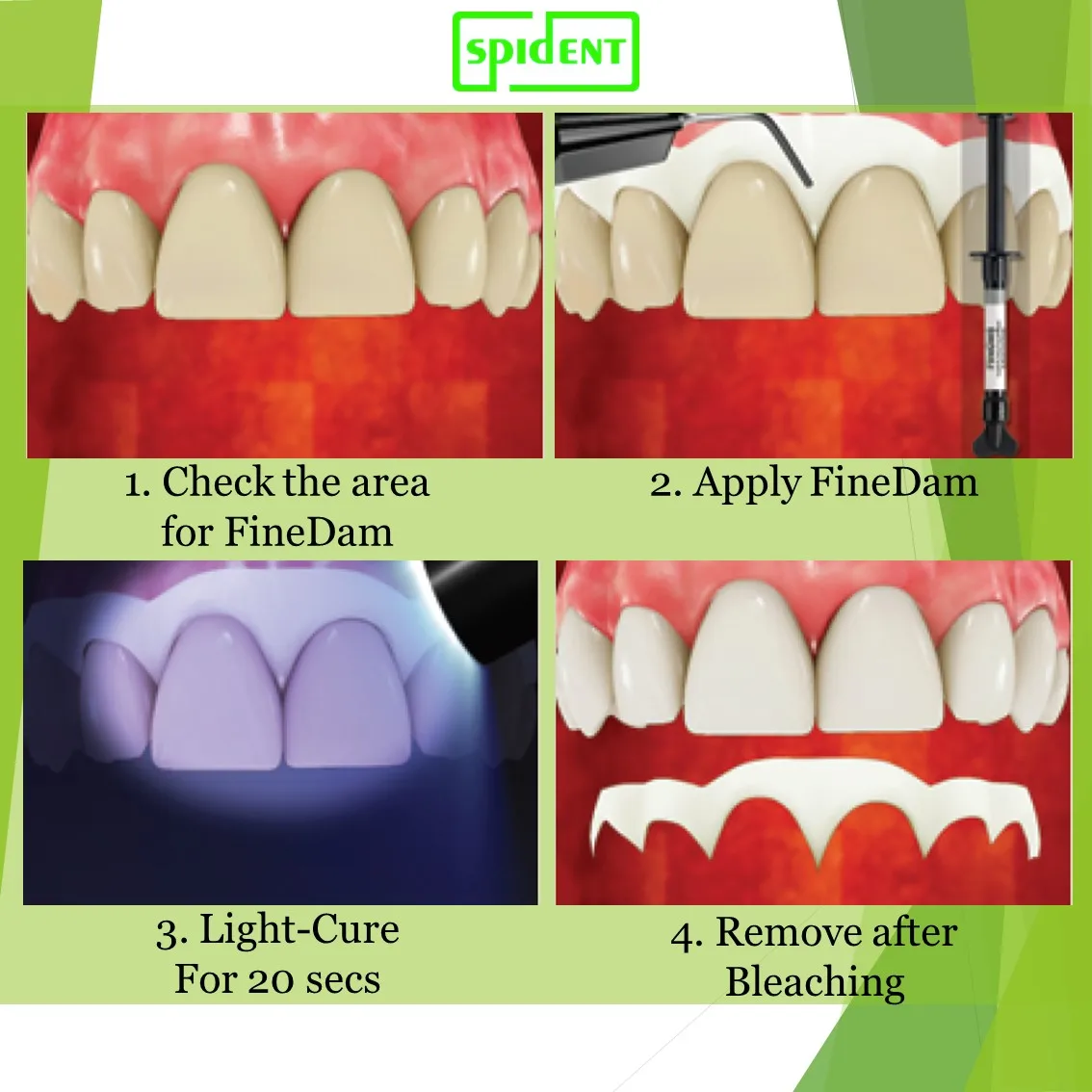 Dental Light Cured Liquid Dam Based Resin Barrier For Cosmetic Buy