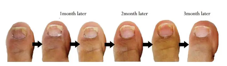 HNC factory finger nail treatment Onychomycosis device