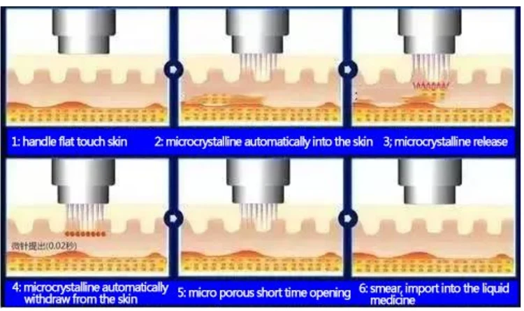 Gold RF Micro crystal machine.jpg